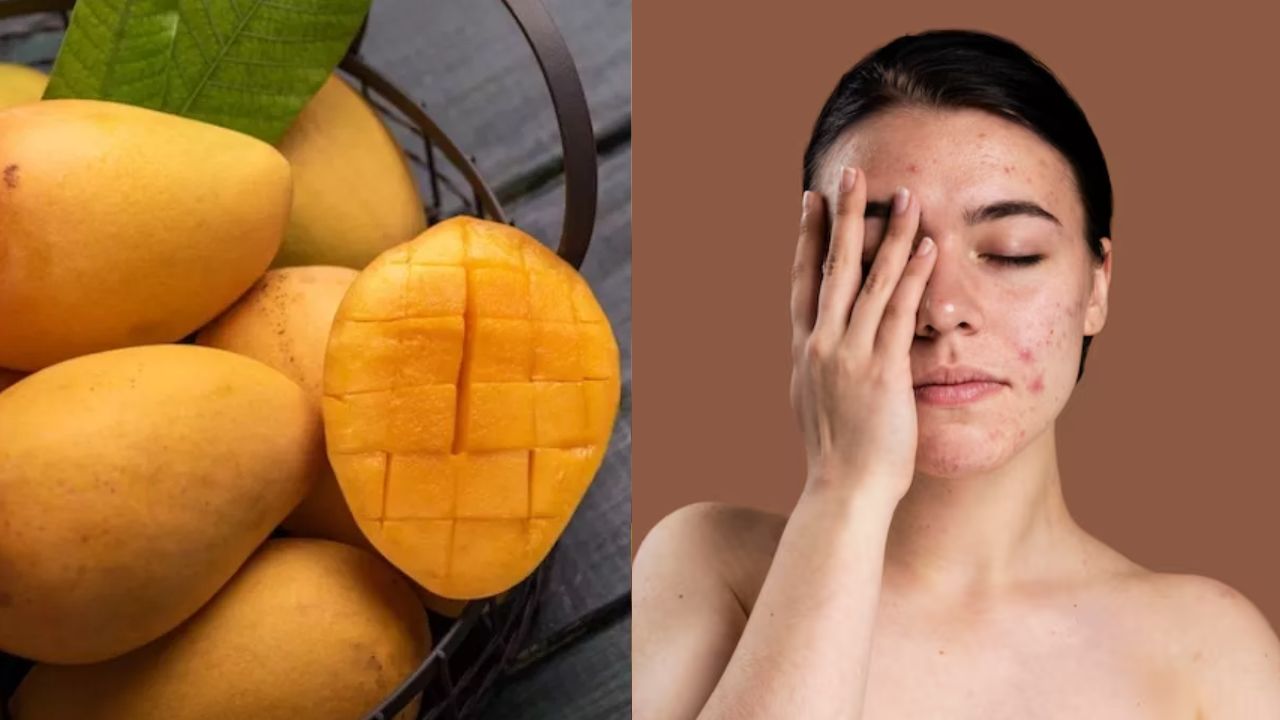 mango can cause pimples