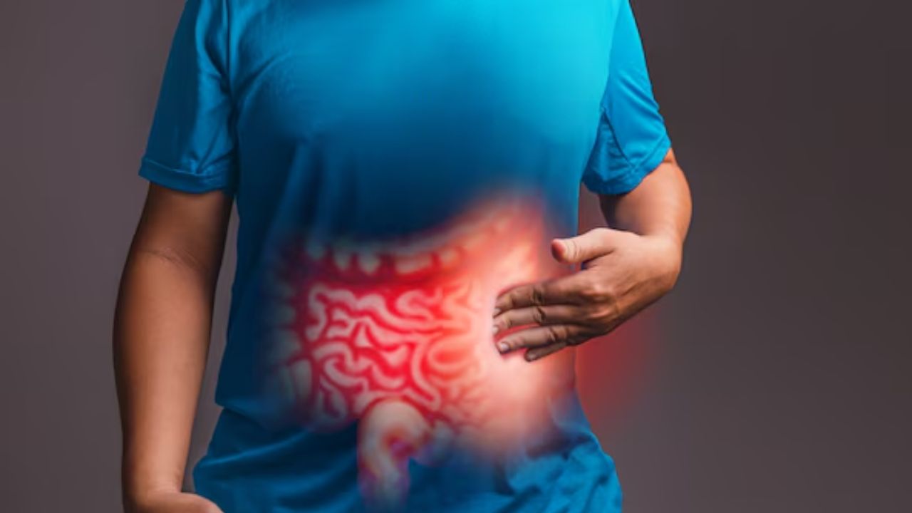 Irritable Bowel Syndrome