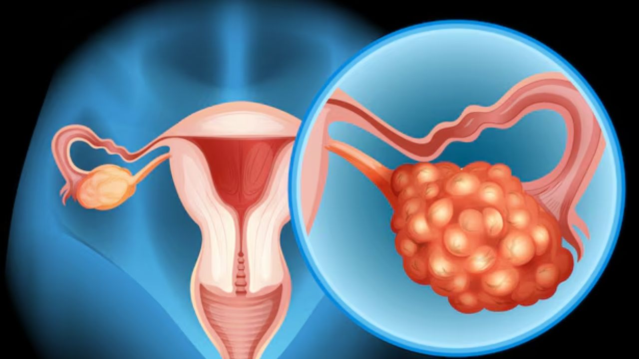 ovarian cancer