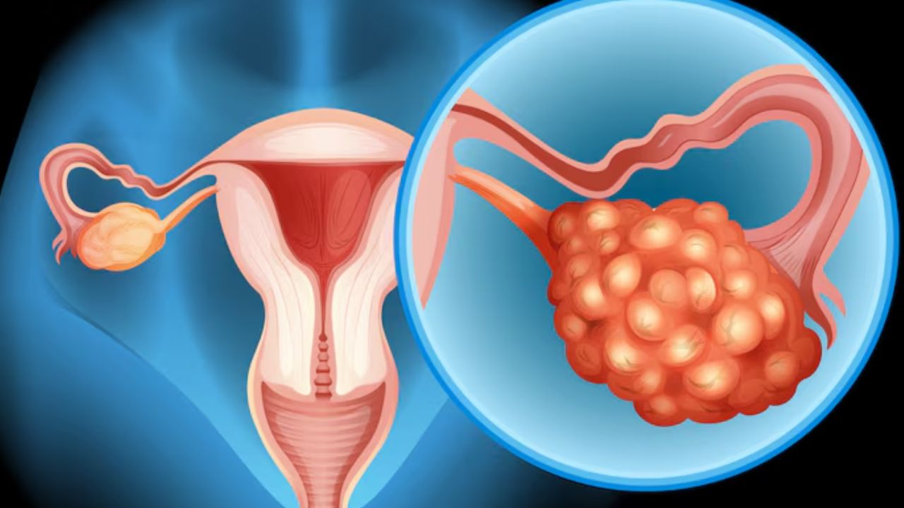 ovarian cancer