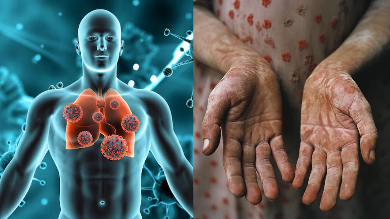 Tuberculosis and leprosy disease