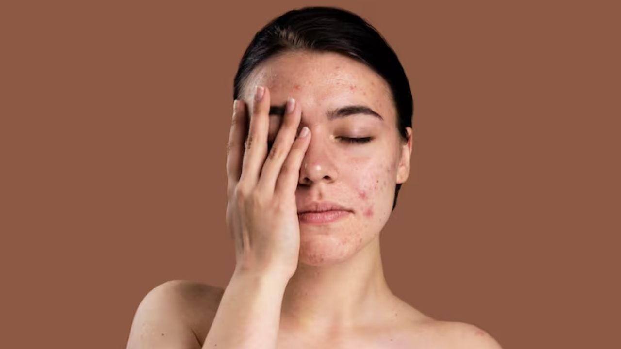 Skin care tips monsoon