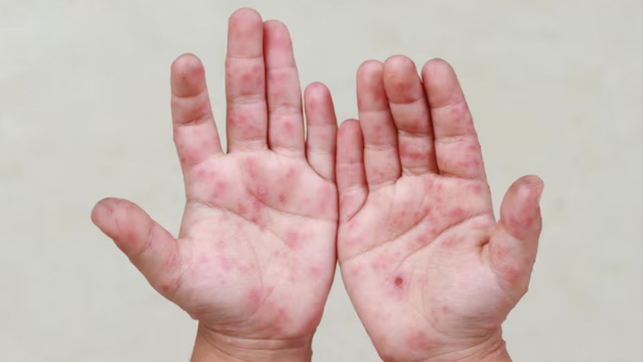 Hand foot mouth disease
