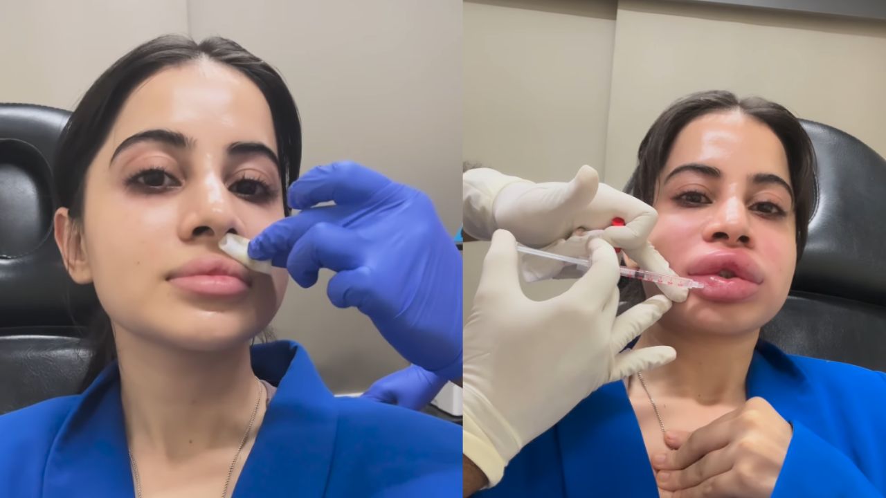 urfi javed lip filler surgery